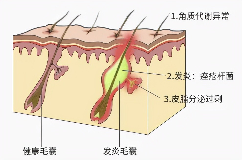 青春痘是怎么形成的,怎么祛除青春痘 - 微医(挂号网)