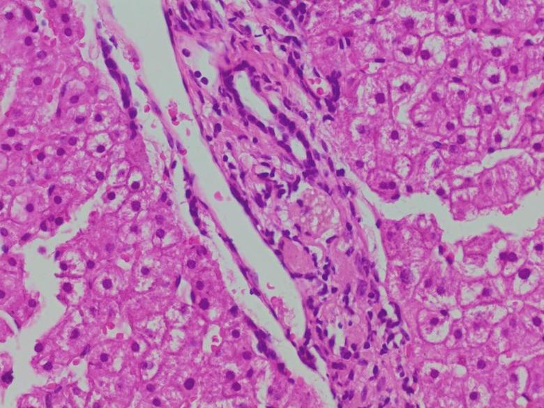 到底有没有"肝硬化"?我们的患者不能随便背这个锅!