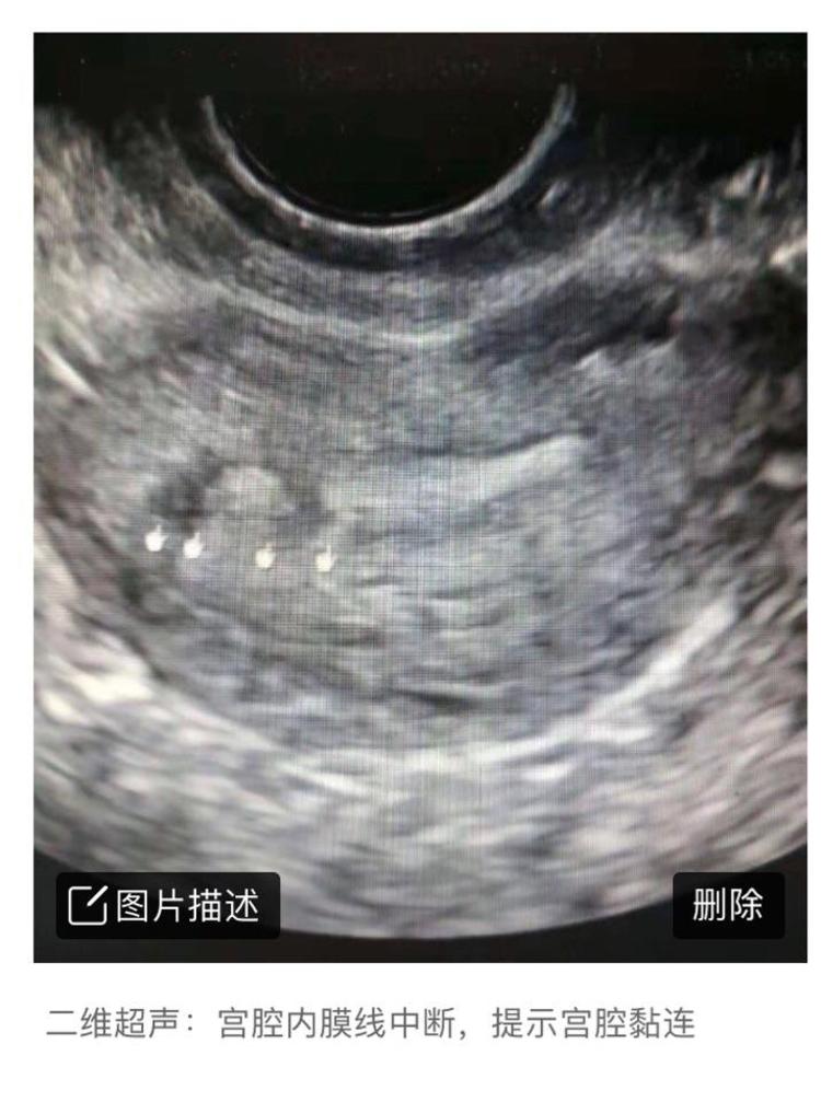 为什么宫腔粘连手术后容易复黏