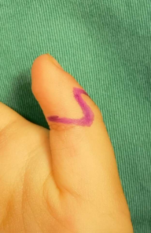 大拇指弯曲的常见原因,三节拇