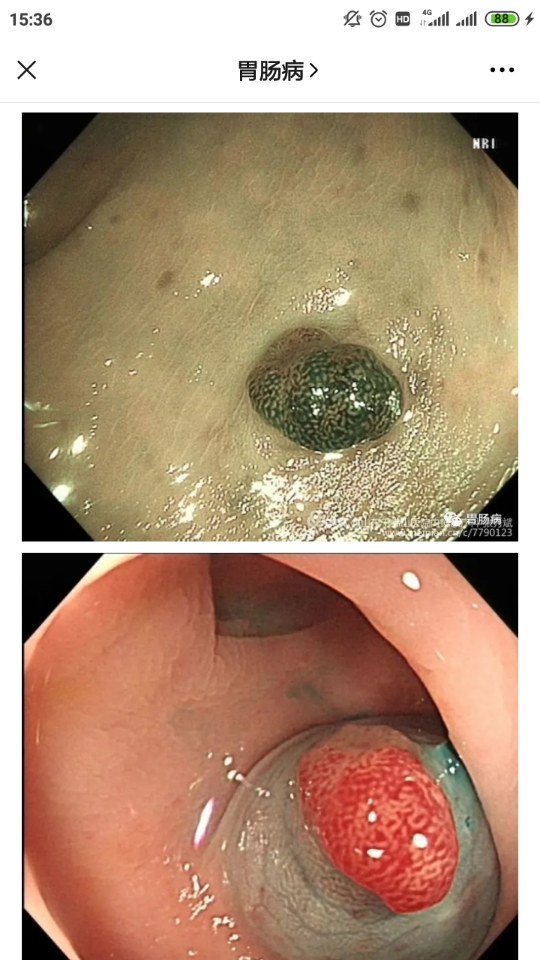 直肠腺癌图片肠镜图片