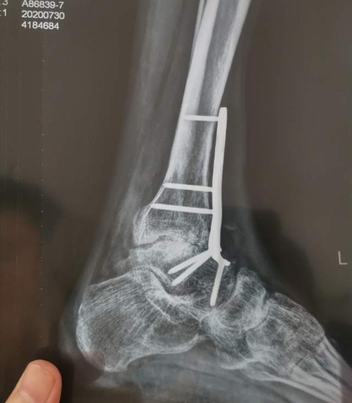 于是就在山东一家省级医院做了关节融合术,病取出胫腓骨之间的大部分
