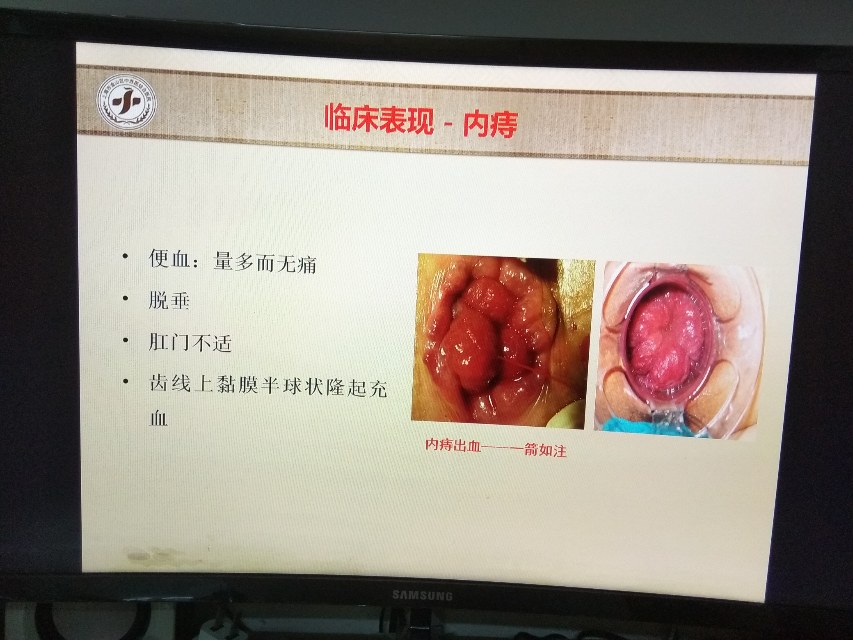 痔疮应及时到正规医院肛肠科就诊否则可导致严重贫血甚至大出血