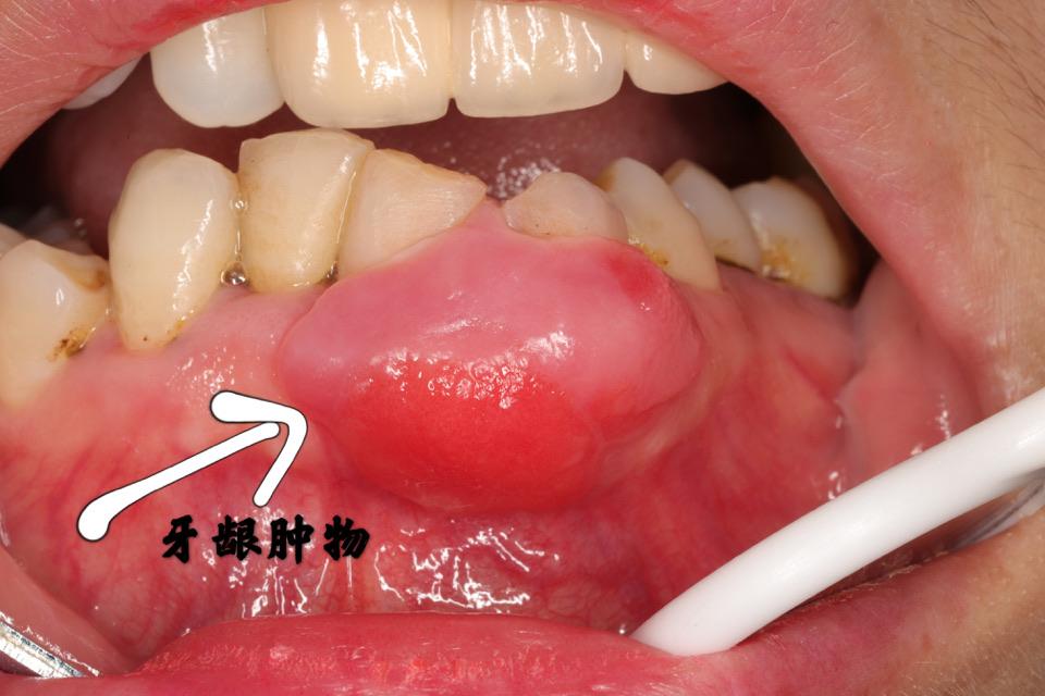 牙龈瘤门诊手术微创摘除