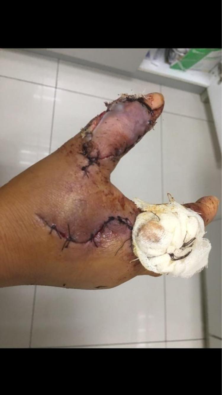 右手拇指热压伤 - 微医(挂号网)