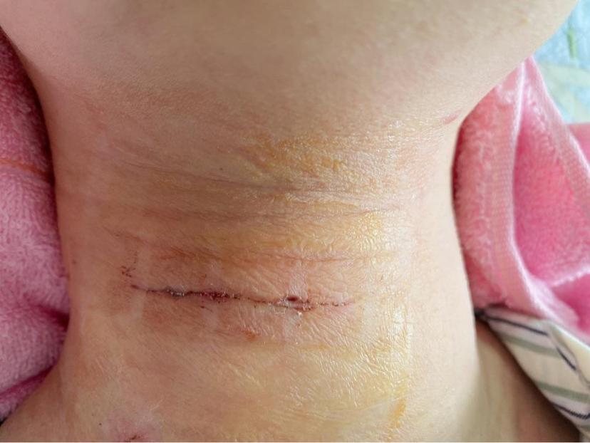 前路微创手术治疗颈椎病