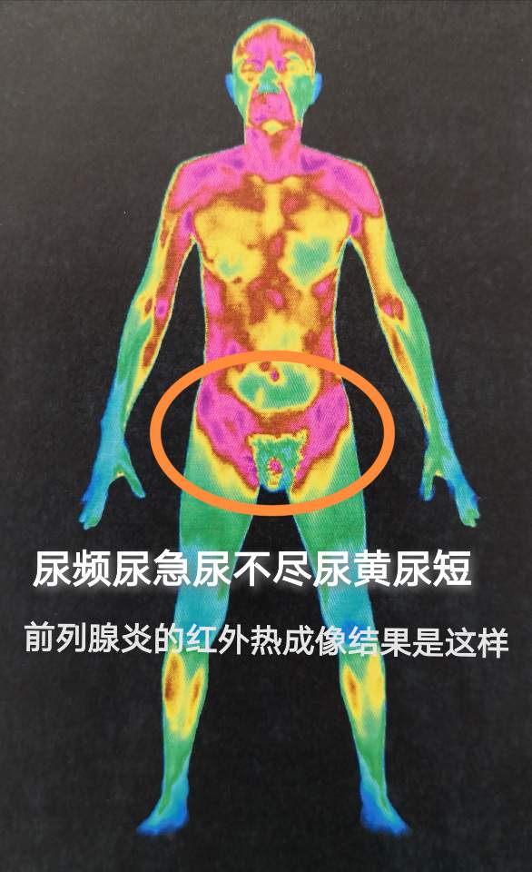 腹痛尿频尿急尿不尽尿黄尿臭是否有前列腺炎?照照红外成像就可知道