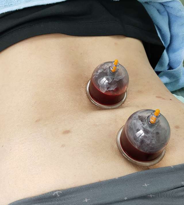 络刺放血,"放"走腰痛 - 微医(挂号网)