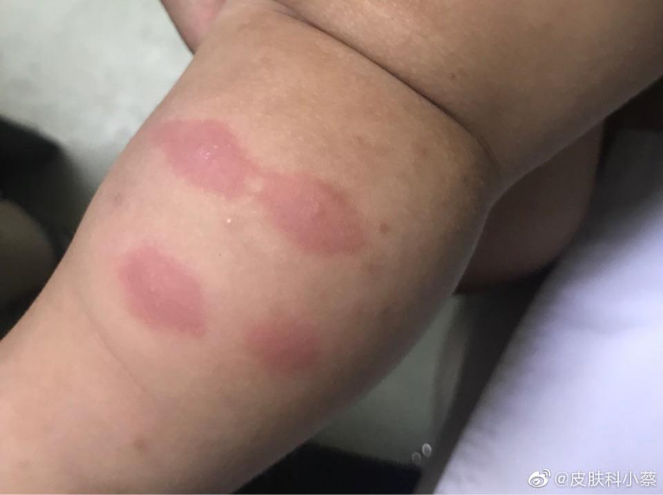 丘疹性荨麻疹,通俗讲就是虫咬皮炎,不是荨麻疹.