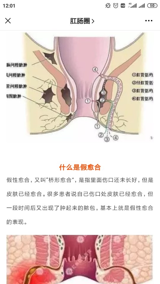 半马蹄肛瘘图图片