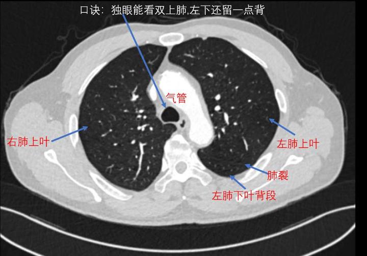 看见左右主支气管(双眼)层面:右肺上叶前段和右肺下叶背段,左肺上叶和