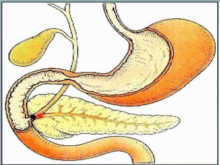 为什么胆总管结石无论有没有症状都要及早治疗微创的治疗方法有哪些