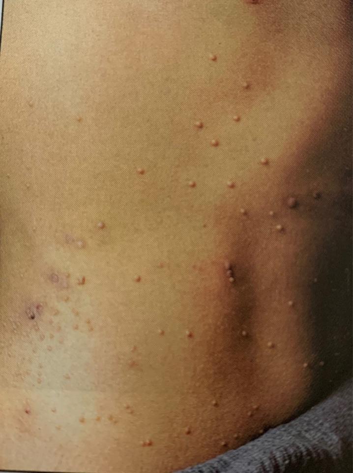 传染性软疣中西医结合治疗