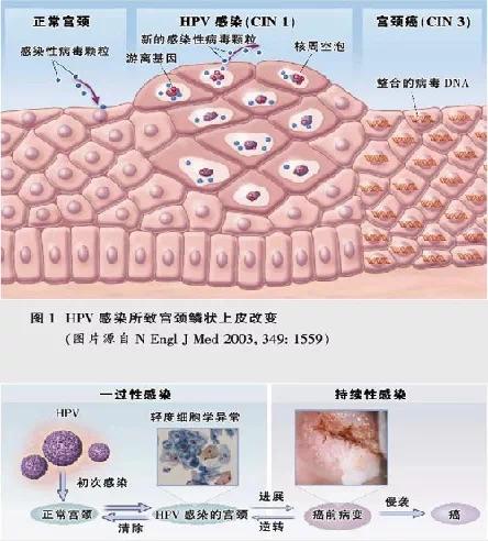 【专题精讲】hpv及子宫颈鳞状上皮低级别病变 - 微医(挂号网)