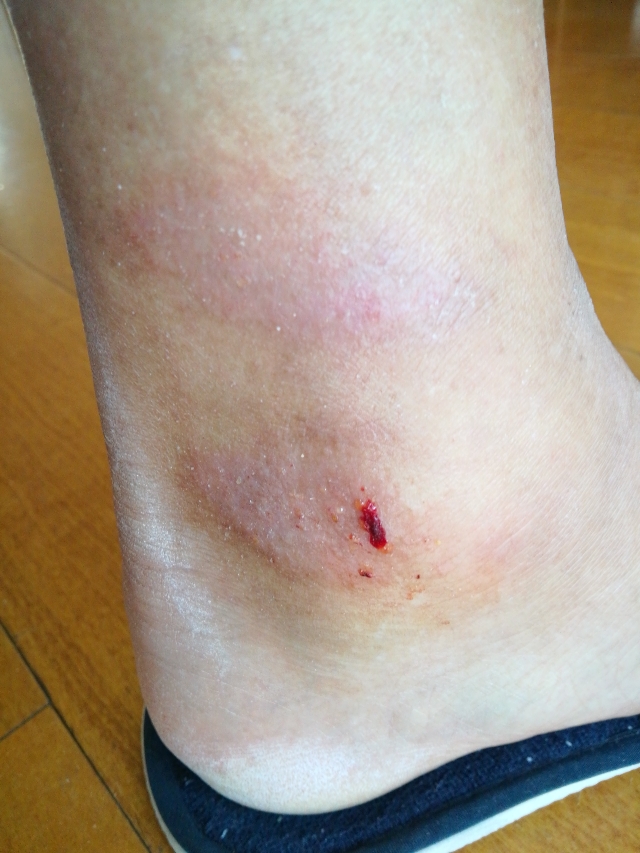 神经性皮炎 - 微医(挂号网)