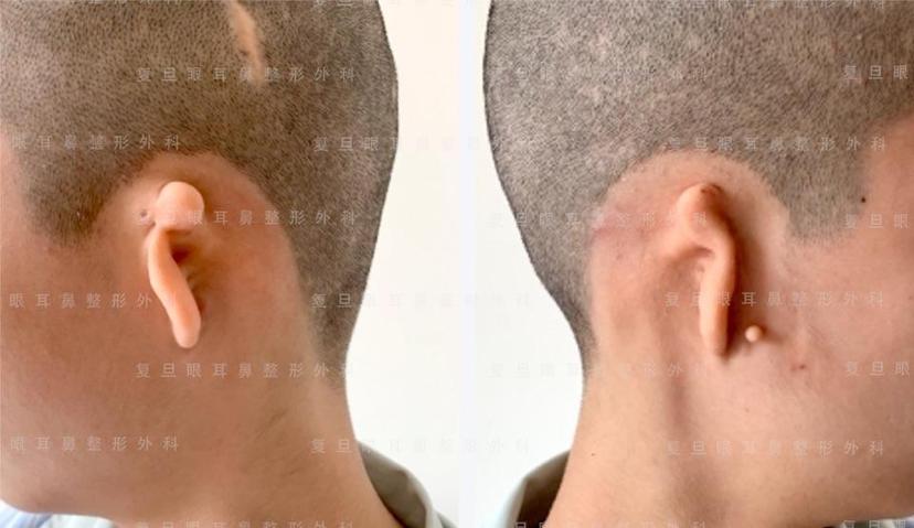 2020年10月14日,我们团队完成首例自体肋软骨双侧同期全耳廓再造术.