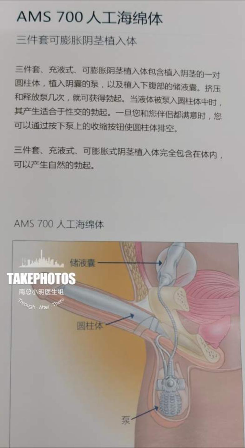 华南地区首次同时完成两台人工阴茎海绵体植入术治疗勃起功能障碍