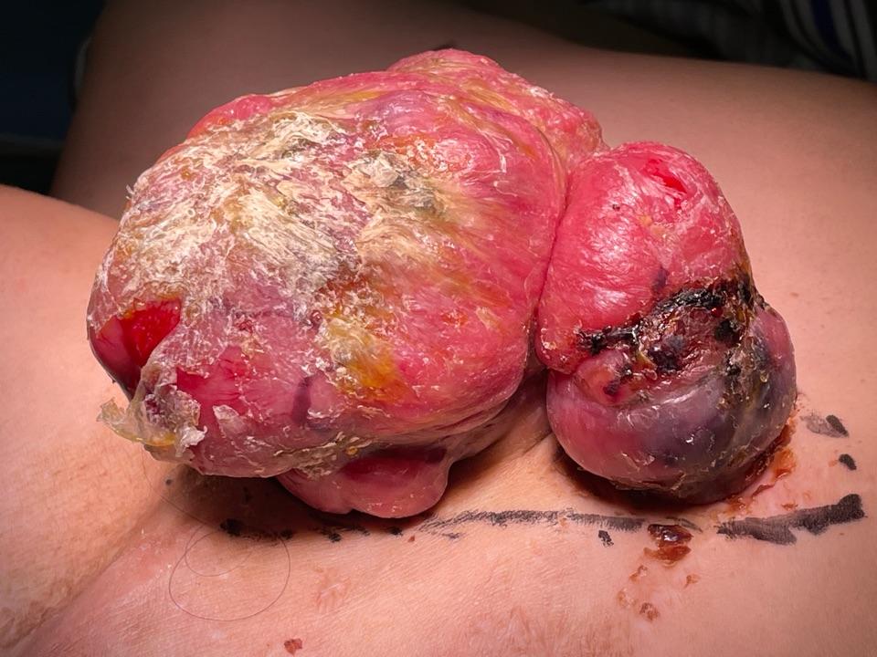 肉瘤是什么样子的图片图片