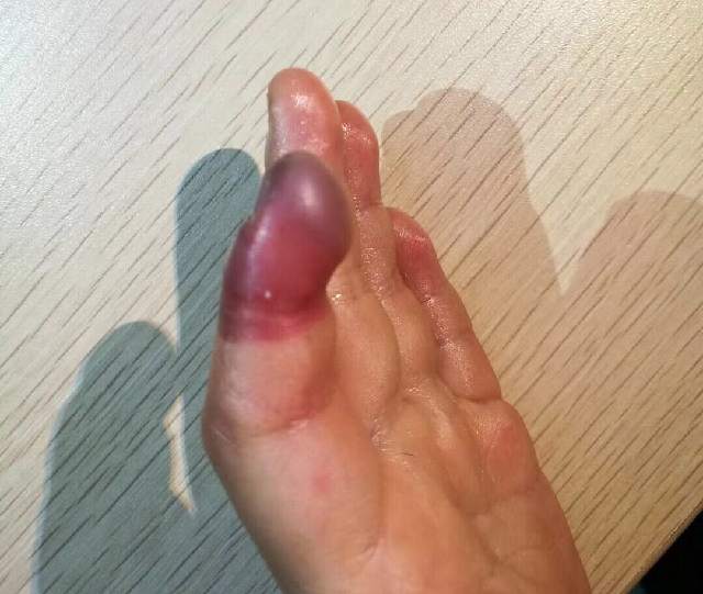 的乐乐(化名)将皮筋缠在手指上玩耍时睡着了,导致左手食指缺血性坏死