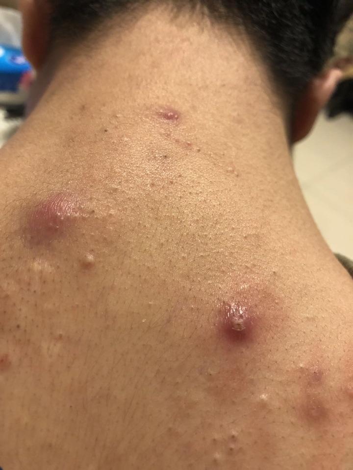 27岁男后背疙瘩求治疗