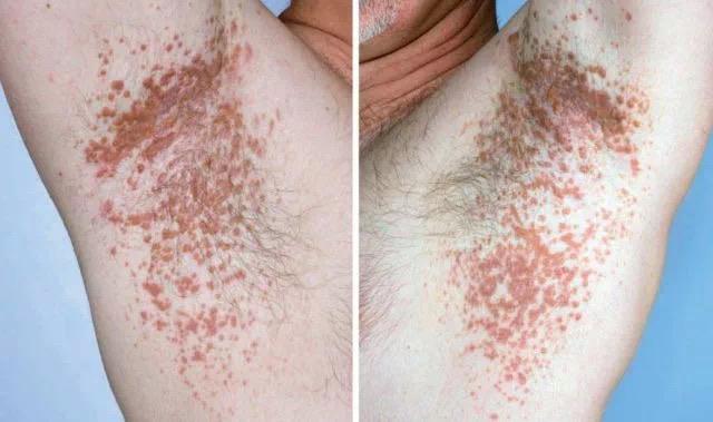 脓疱疮的蜜黄色痂(a)和脓疱(b)(来源:goldsmithla等,2012)6.