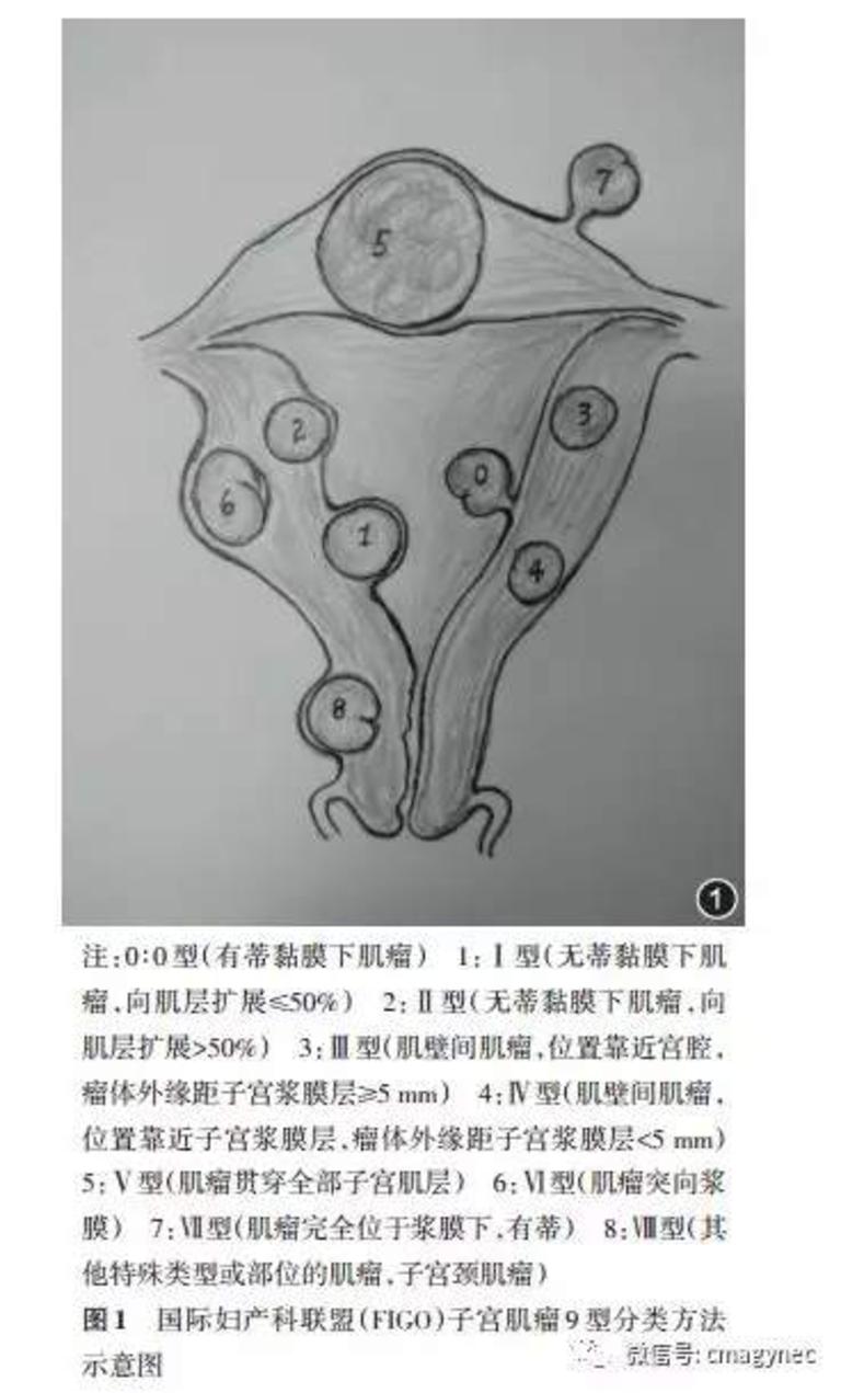 子宫肌瘤详细分类