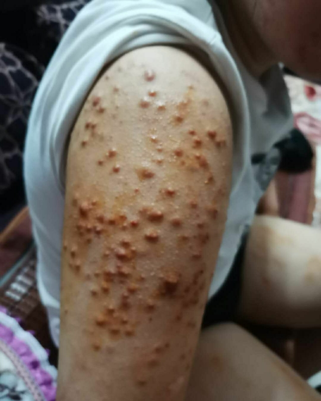 手臂后背前胸长痘痘是因为什么