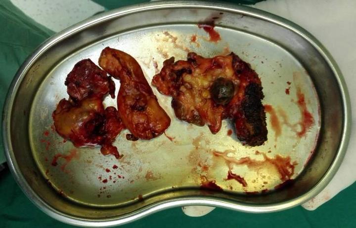 神秘的黄色肉芽肿_尹磊医生文章_海军军医大学第三附属医院(东方肝胆