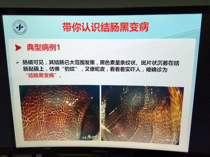 带你认识结肠黑变病的临床表现及治疗上