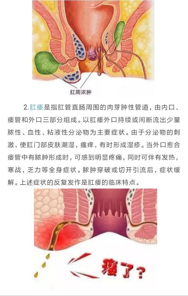 肛瘘和痔疮的区别图片