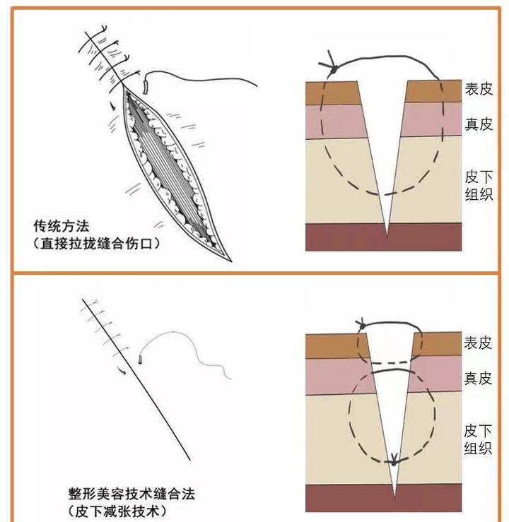普通缝合or超减张精细缝合