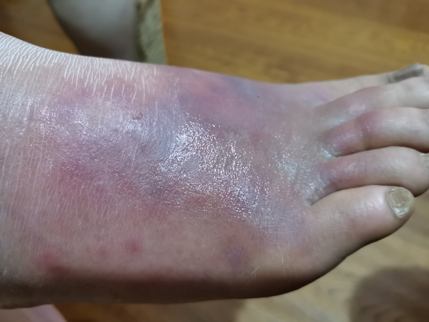 后右脚脚面又发红点,红肿发紫,摸起来发烫,不能落地走路,疼痛难忍.