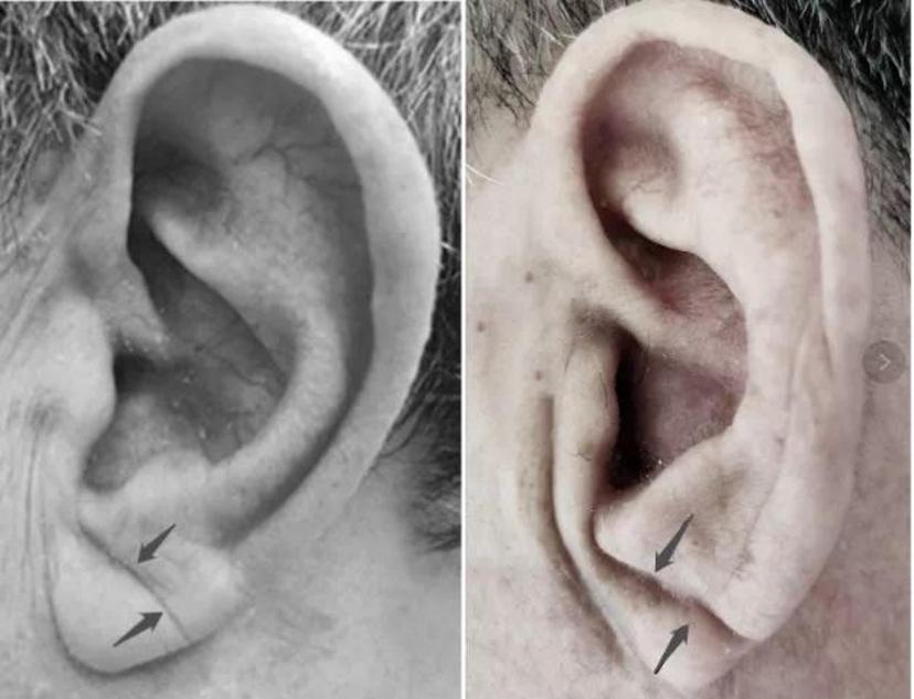 耳垂褶皱提示心脑血管病快看看你的耳朵