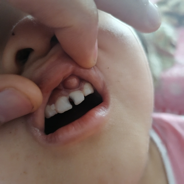 小孩牙肉上长牙齿图片图片