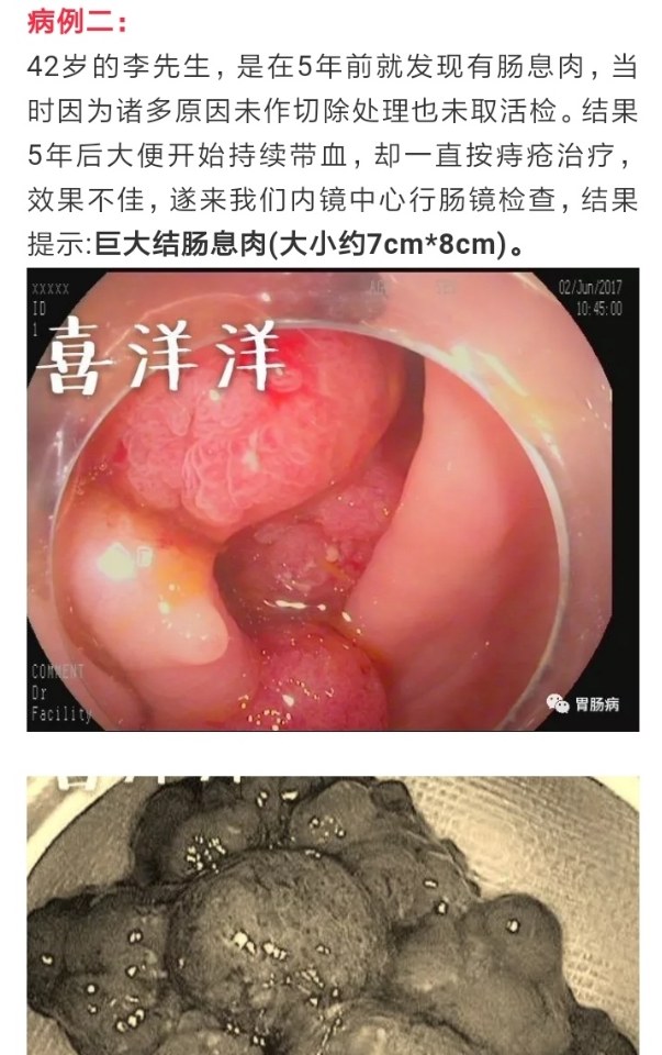 帶你認識腺瘤性腫瘤性息肉