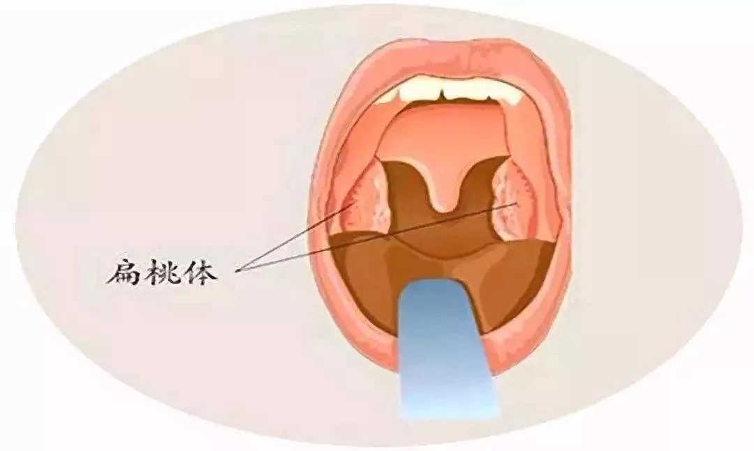 扁桃腺,又稱扁桃體,是人和兩棲類以上動物,鼻後孔的頂壁或咽與口腔