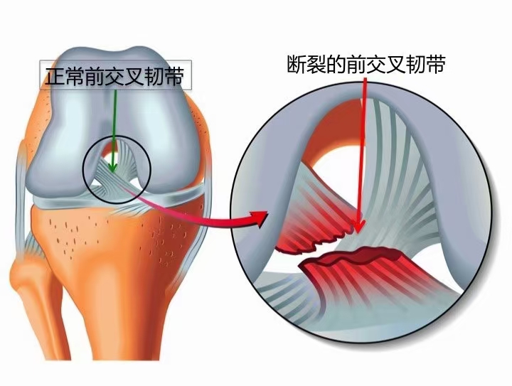 前交叉韧带核磁解剖图图片