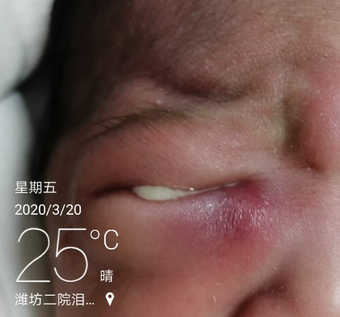 如果是发生先天性泪囊囊肿,又叫泪囊突出,羊水囊肿,则表现为出生的