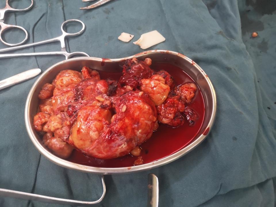 2例复杂纵隔肿瘤切除 - 微医(挂号网)