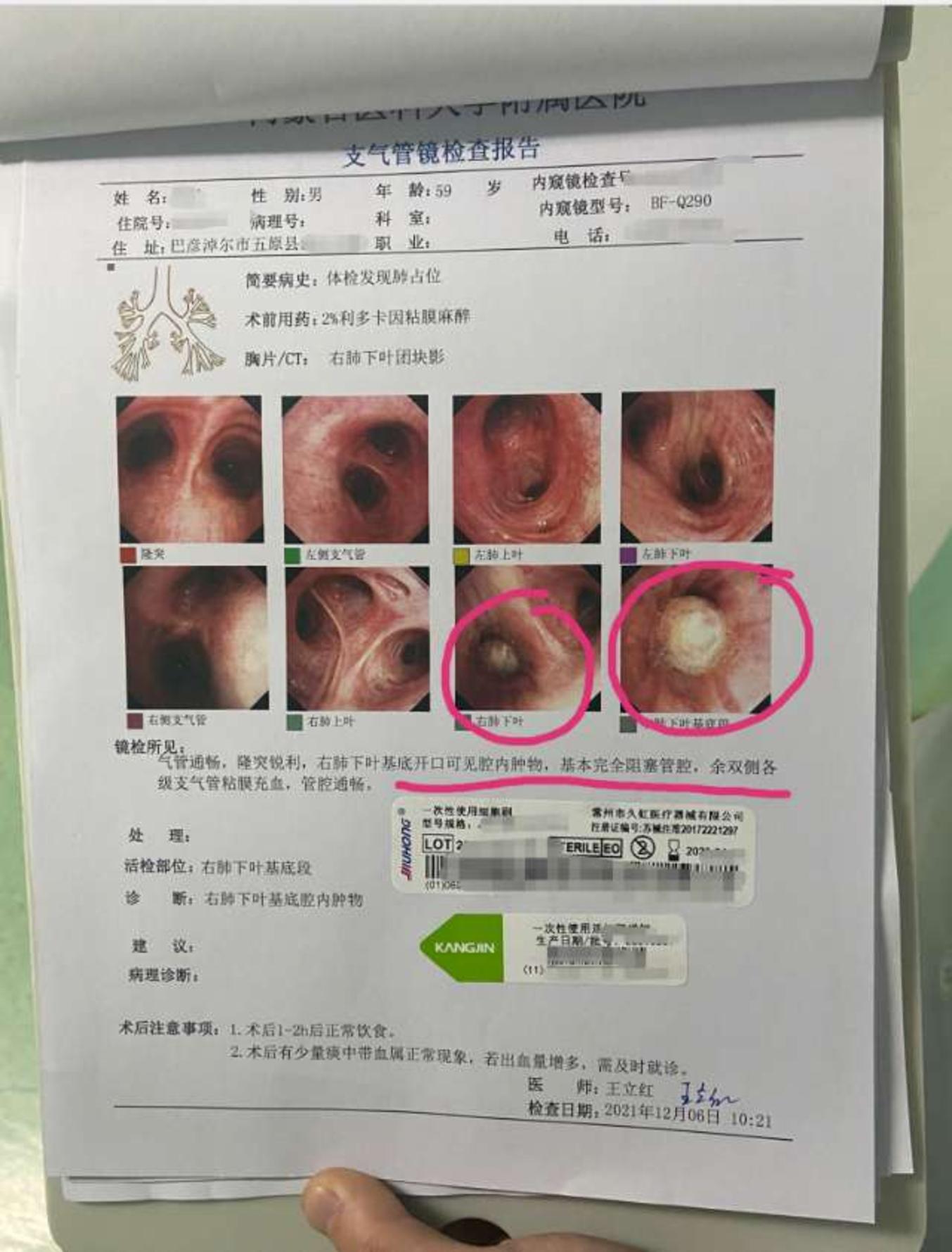 刘懿博士说肺癌三〇七六中央型肺癌长什么样气管镜里就能看到