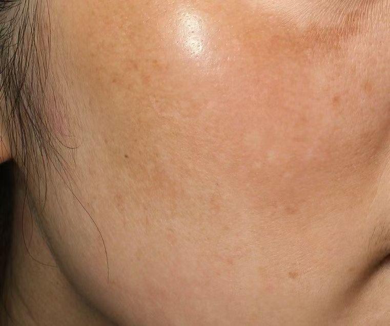 黄褐斑是一种多见于中青年女性面部对称性的色素沉着性皮肤病,常发生