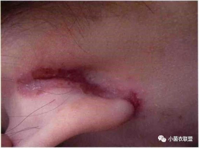 关于湿疹你究竟了解多少? - 微医(挂号网)