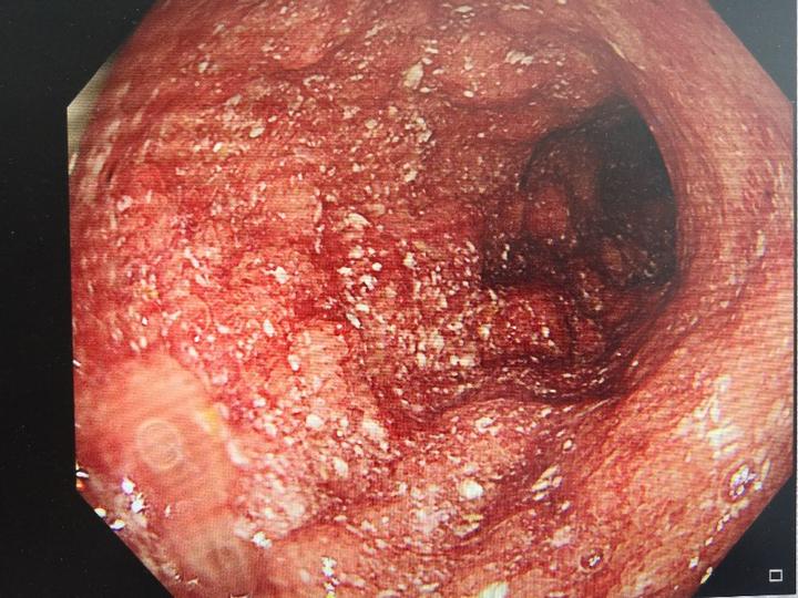 青玉散让中重度广泛结肠型溃结基本痊愈