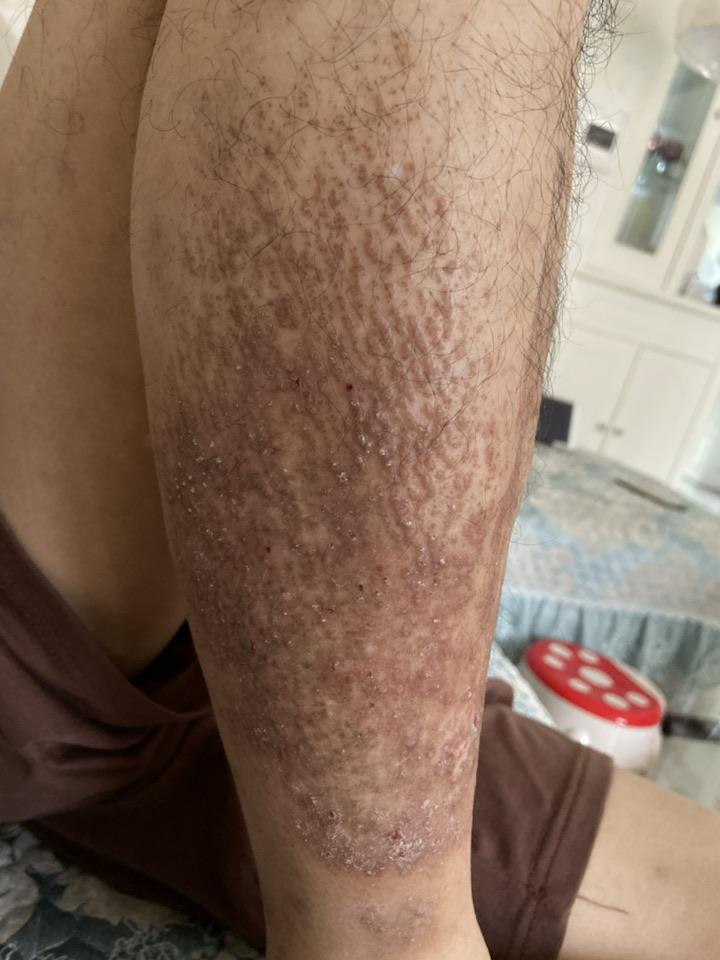 不知道脚上长的是什么,奇痒,一块块发黑.