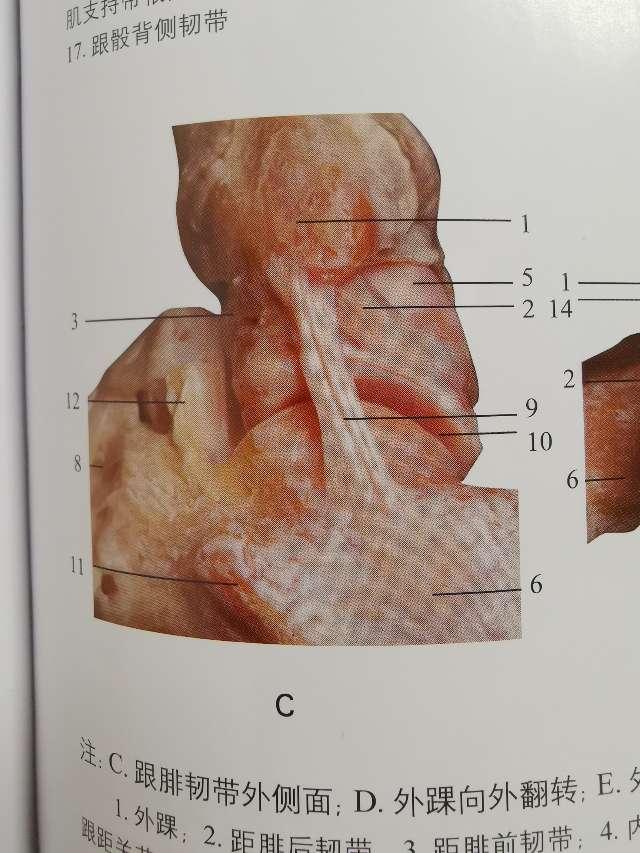 距腓前韧带断裂