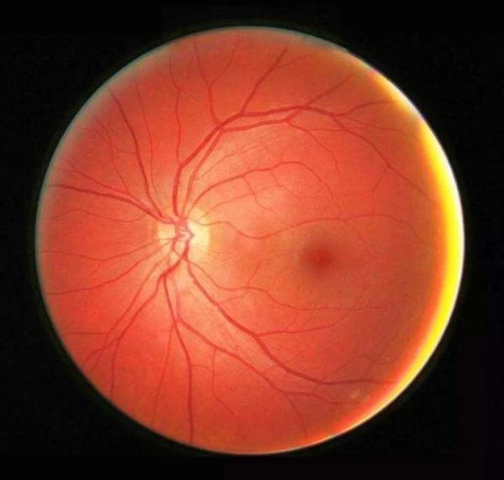 正常的眼底犹如丝绸般光泽,眼底照相可以呈现出各种视网膜病变.