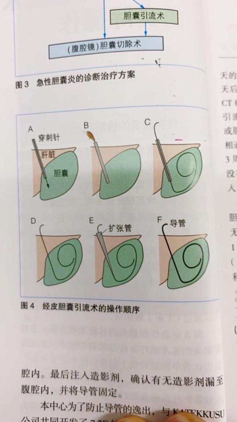 炎伴有器官功能障碍需急诊行胆囊穿刺引流,二期行腹腔镜胆囊切除术
