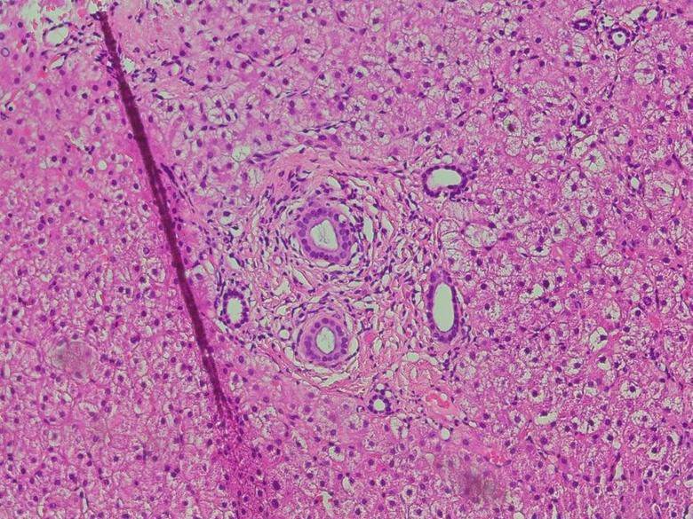 到底有没有"肝硬化"?我们的患者不能随便背这个锅!