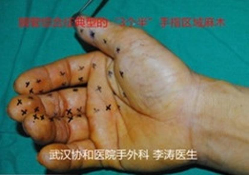 微创小切口治疗腕管综合征与传统长切口的优势比较