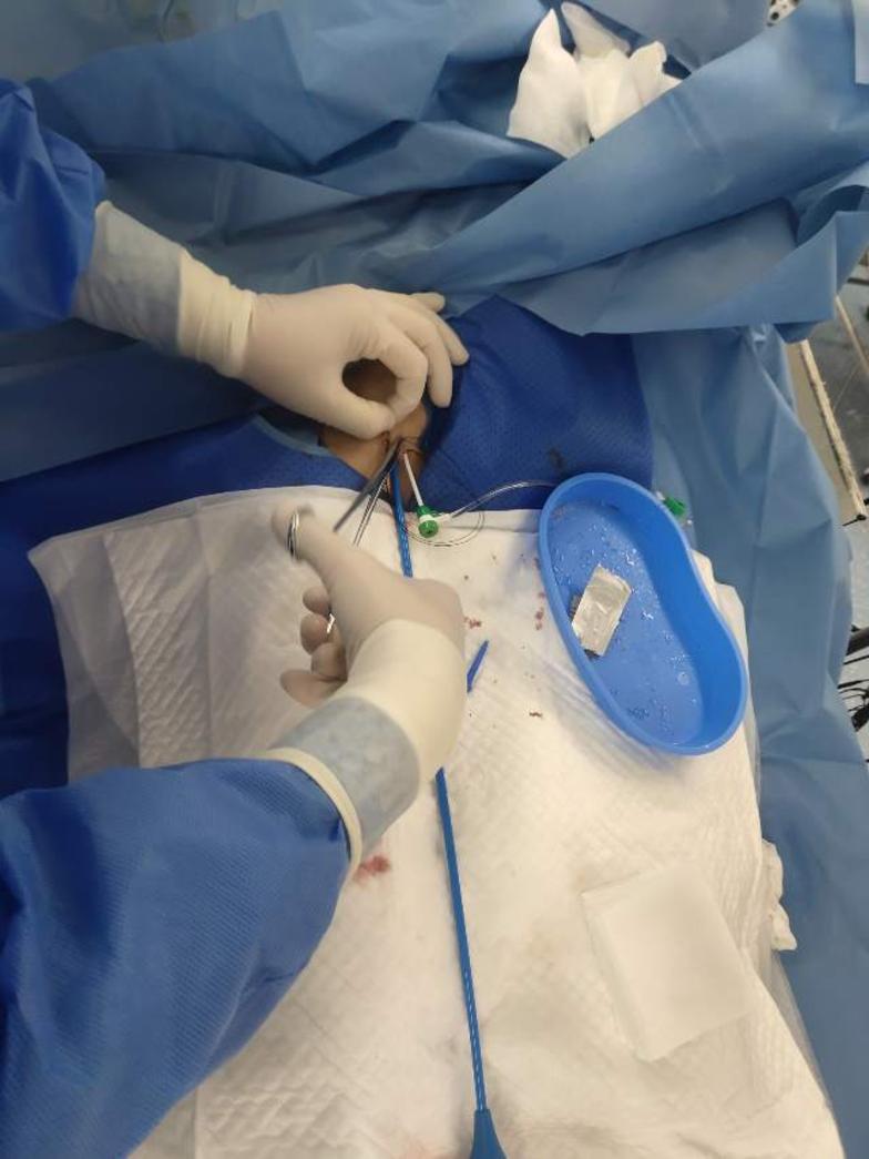 房间隔穿刺及左心房造影4.放置冠状窦电极和心室电极3.局麻